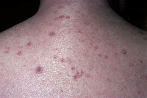 Raised Red Bumps On Skin
