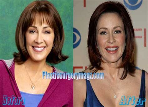 Patricia Heaton Plastic Surgery Before And After