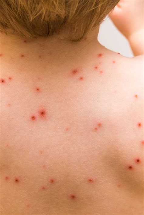 Red Bumps On The Back Healthfully