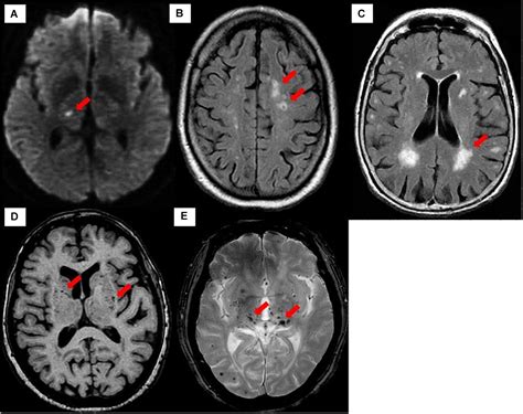 Frontiers Cerebral Small Vessel Disease Csvd Lessons From The