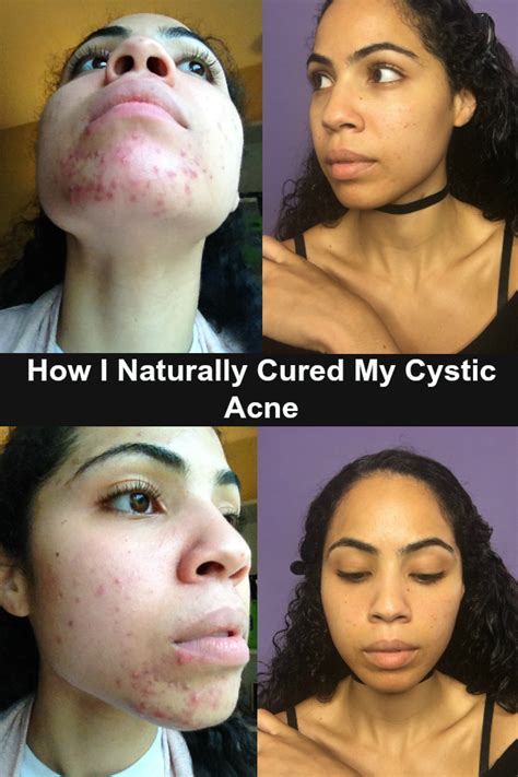 How I Naturally Cured My Hormonal Cystic Acne Remove Dairy Heal The Gut And Consume