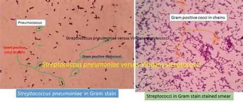 Streptococcus Pneumoniae Versus Viridans Streptococci
