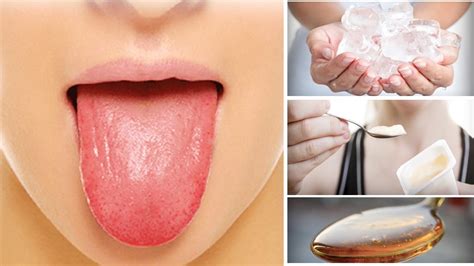 Top 6 Natural Cures For Burnt Tongue Faster How To Soothe A Burnt Tongue Youtube