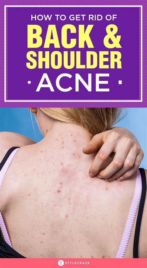 How To Get Rid Of Back Acne Naturally Acne Naturally Rid