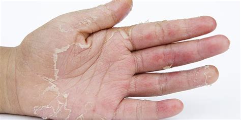 Palmas Das Mãos Descascando O Que Pode Ser Causas E Tratamentos