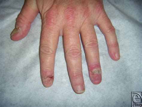 Photograph Of 46 Year Old Women With Multiple Scaly Lesions Of Both