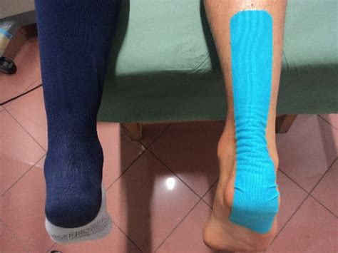 La terapia fisica serve a ridurre il dolore in caso di quali sono gli altri rimedi che si possono adottare per un tendine d'achille gonfio? Tratamento para tendinite de Aquiles, sintomas e remédios ...