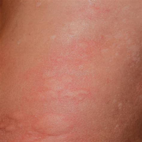 Pollen Allergy Skin Rash Pictures