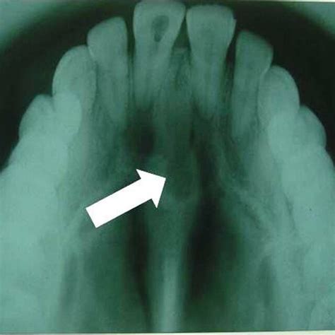 Gross Specimen Figure 3 Intra Oral Periapical Radiograph View