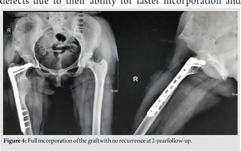 Pdf A Case Report Of Aneurysmal Bone Cyst With Pathologic Fracture Of Proximal Femur Managed