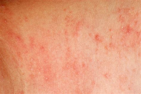 Dr Kletz Contact Dermatitis Allergist Washington Dc