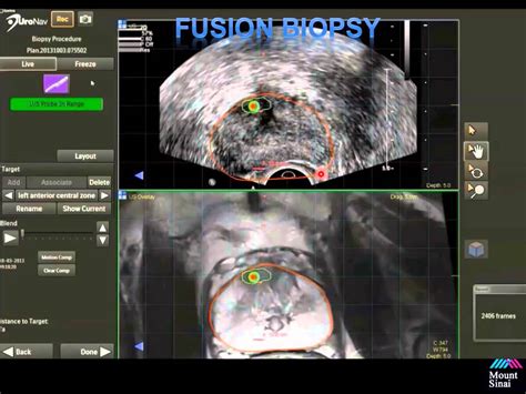 Rastinehad Fusion Guided Prostate Biopsy Uronav Youtube