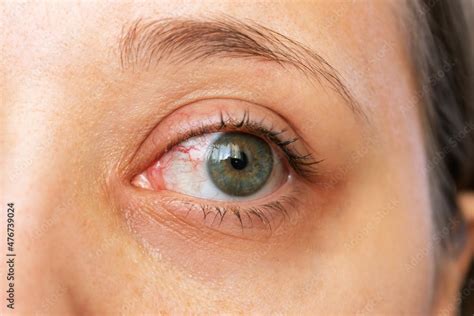 New Diagnostic Option For Rare Eye Disease