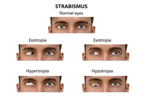 Adult Strabismus Associated Eye Care