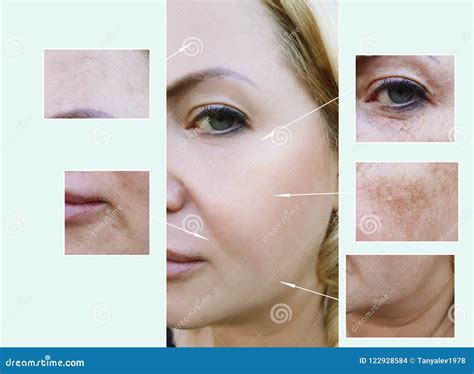 Woman Face Wrinkles Before And After Aging Procedures Pigmentation