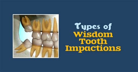 Types Of Wisdom Tooth Impactions Horizontal Impaction Vertical