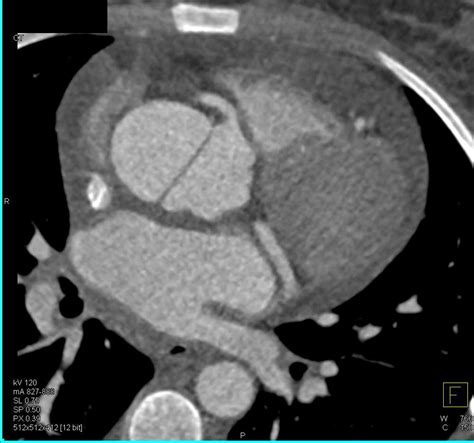 Type A Aortic Dissection Cardiac Case Studies Ctisus