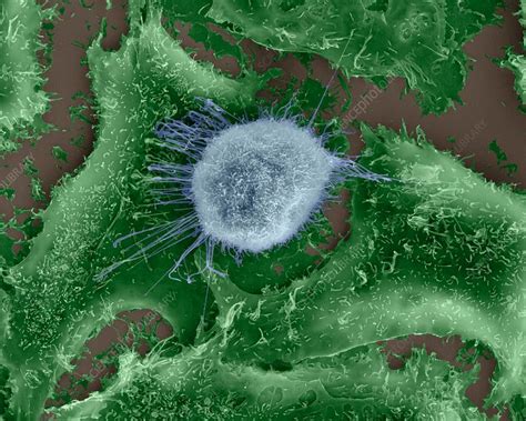 Lung Epithelial Cancer Cell Among Healthy Epithelia Sem Stock Image