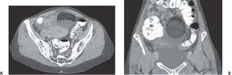 137 Adnexal Torsion Secondary To Ovarian Dermoid Radiology Key