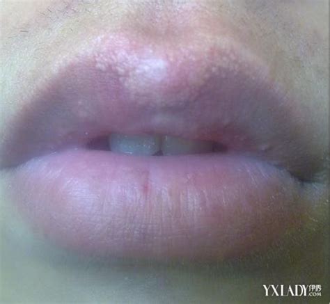【图】嘴唇上长小白点图解 搞清6大原因对症下药嘴唇上长小白点图伊秀美容网