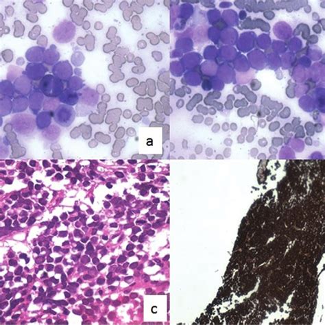 Pdf Proptosis A Rare Presentation Of Acute Myeloid Leukemia − Aml M6