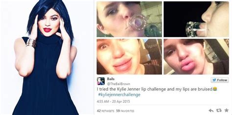 Too Far People Bruise And Make Their Lips Swell To Achieve Kylie Jenners Pout With Trending