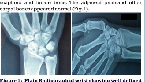 Figure From Intraosseous Ganglion Cyst Of Scaphoid And Lunate A Case Report Semantic Scholar