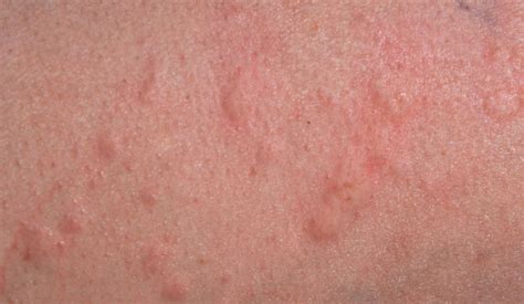 Hives Urticaria Allergies And Health