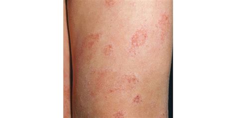 Red Scaly Rash Pictures Photos