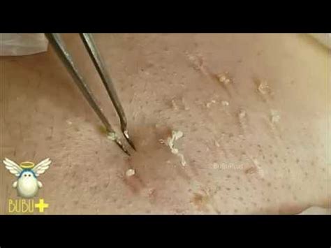 Cara menghılangkan komedo secara maksımal! Pinset komedo | jepitan komedo | pembuka komedo - YouTube