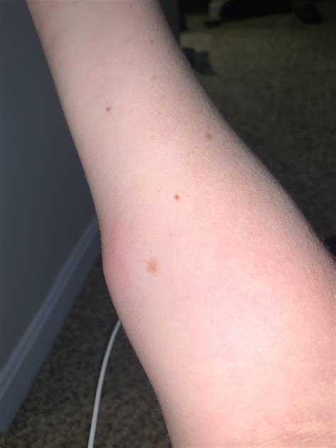 Large Hardswollen Itchy Red Bumps All Over Arms Last For Two Weeks