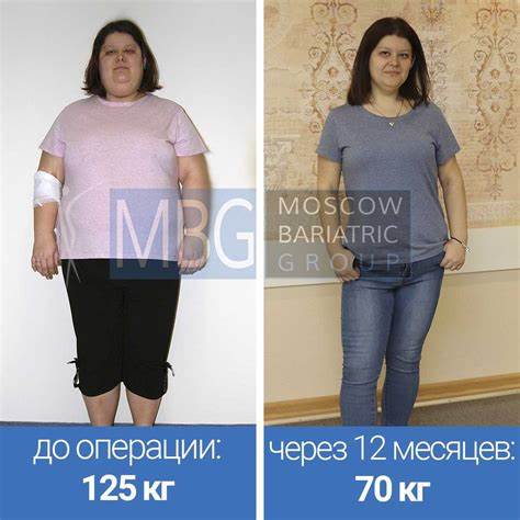Операция желудка чтобы похудеть