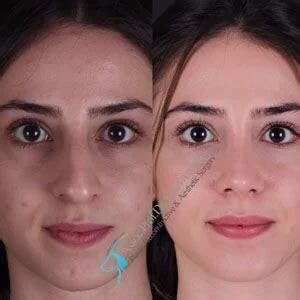 Nose Surgery In Istanbul Turkey Assoc Prof Dr Suleyman TAS