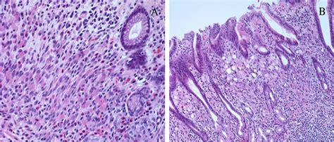 Gastric Carcinoma Morphologic Classifications And Molecular Changes