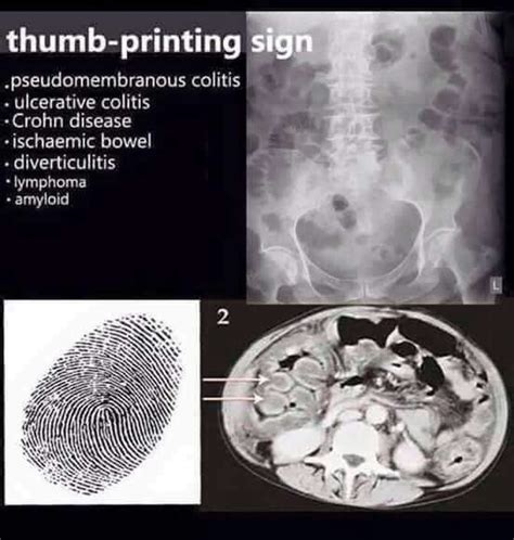 Thumb Printing Sign Xray Abdomen With Images Radiology Medical