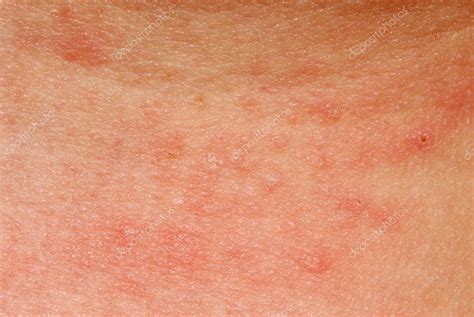 Allergic Rash Dermatitis Skin Texture — Stock Photo © Panxunbin 6947053