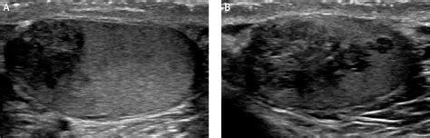 Testicular Adrenal Rest Tumors Diagnosed On Ultrasound With A History