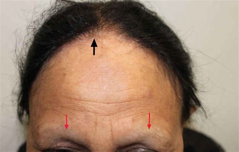 Alopecia Alopecia Causes Symptoms Treatment Alopecia Alopecia