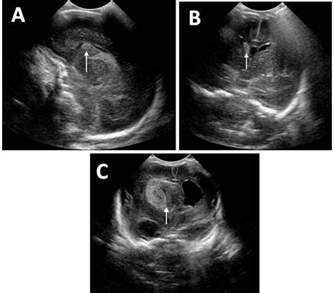 Ultrasound Images Of Infants With Different Grades Of Intraventricular