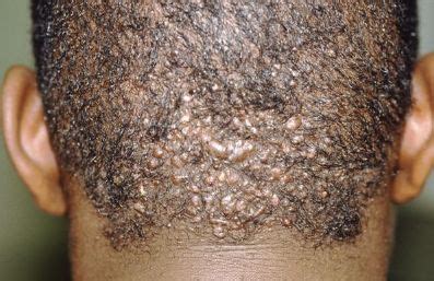 How to spot ingrown hairs. Pimples on Back of Head, under Hair, and Neck, after ...