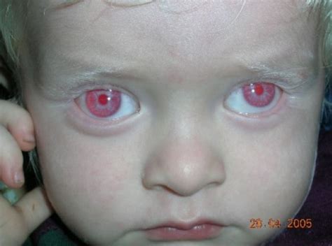 The Most Definitive Feature Of Albinos Red Eyes Albino Human