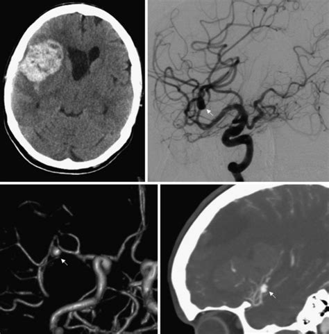 Spontaneous Intracerebral Hemorrhage Neupsy Key