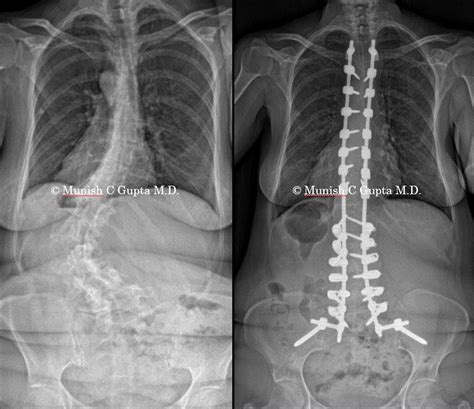 Adult Idiopathic Scoliosis Munish C Gupta Md