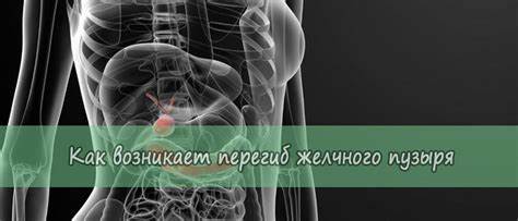 Загиб желчного пузыря какая диета Загиб желчного пузыря лечение народными средствами диета Загиб желчного пузыря лечение народными средствами диета Загиб желчного пузыря какая диета