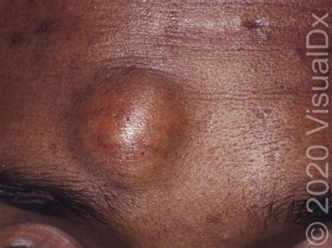 Diagnosing On The Spot A Guide To Solitary Lesions Visualdx Free