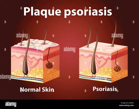 Diagram Showing Plaque Psoriasis Illustration Stock Vector Image And Art