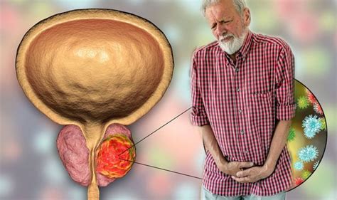 Prostate Cancer Symptoms Signs Include Difficulty Passing Urine Uk