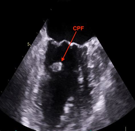 Cureus Cardiac Mass A Case Of Cardiac Papillary Fibroelastoma