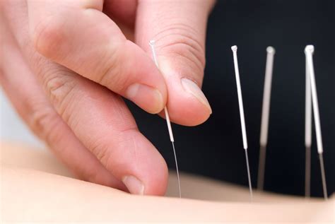 What Is Acupuncture Does Acupuncture Work Live Science