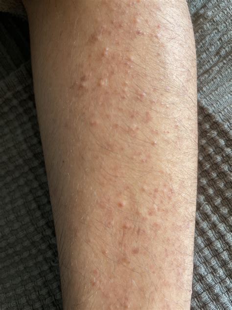 Pimples On Arm Diagnosis Treatment Rskin